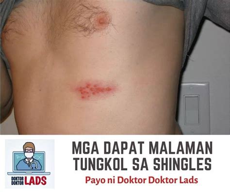 Mga Dapat Malaman Tungkol sa KULEBRA o SHINGLES.